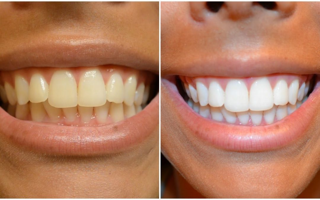 Bandelettes blanchissantes – Un sourire éblouissant sans passer chez le dentiste